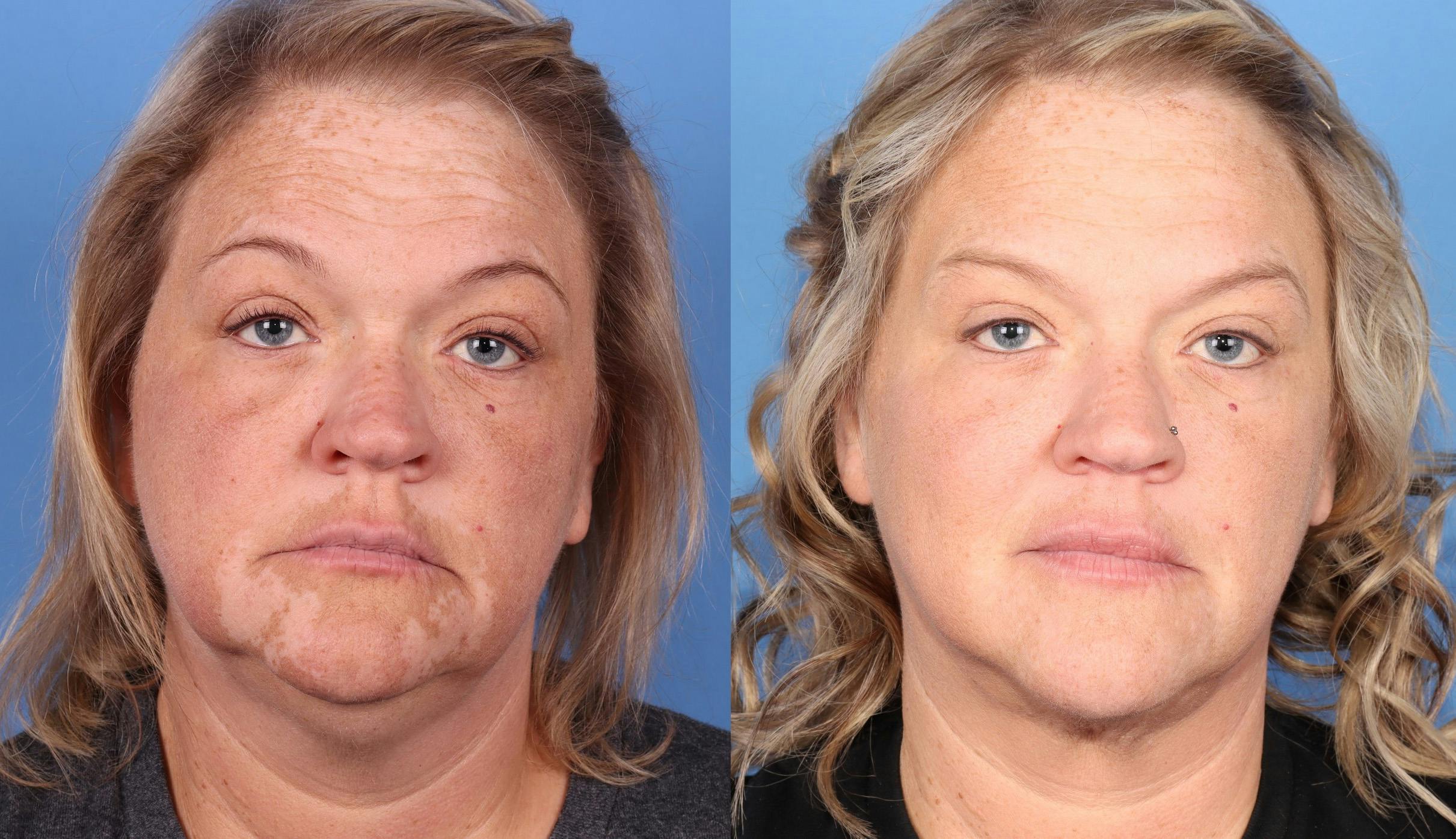Face & Neck Before & After Gallery - Patient 149385109 - Image 1