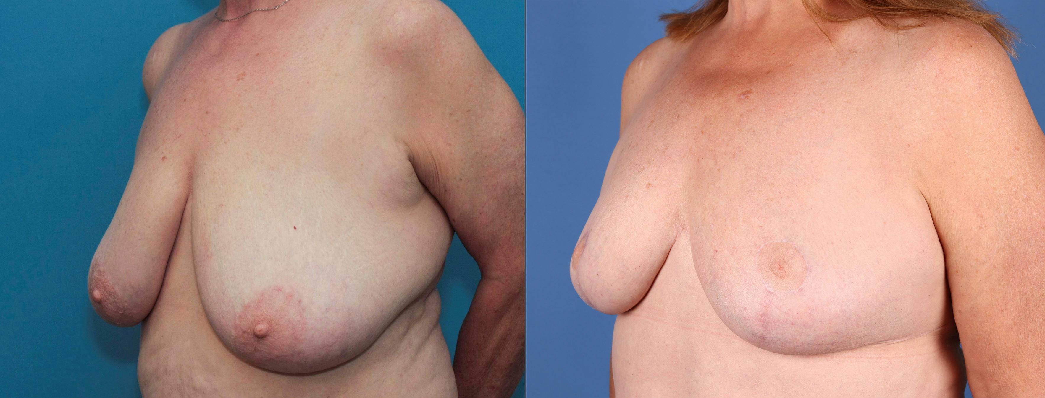 Breast Reduction Before & After Gallery - Patient 141726358 - Image 2