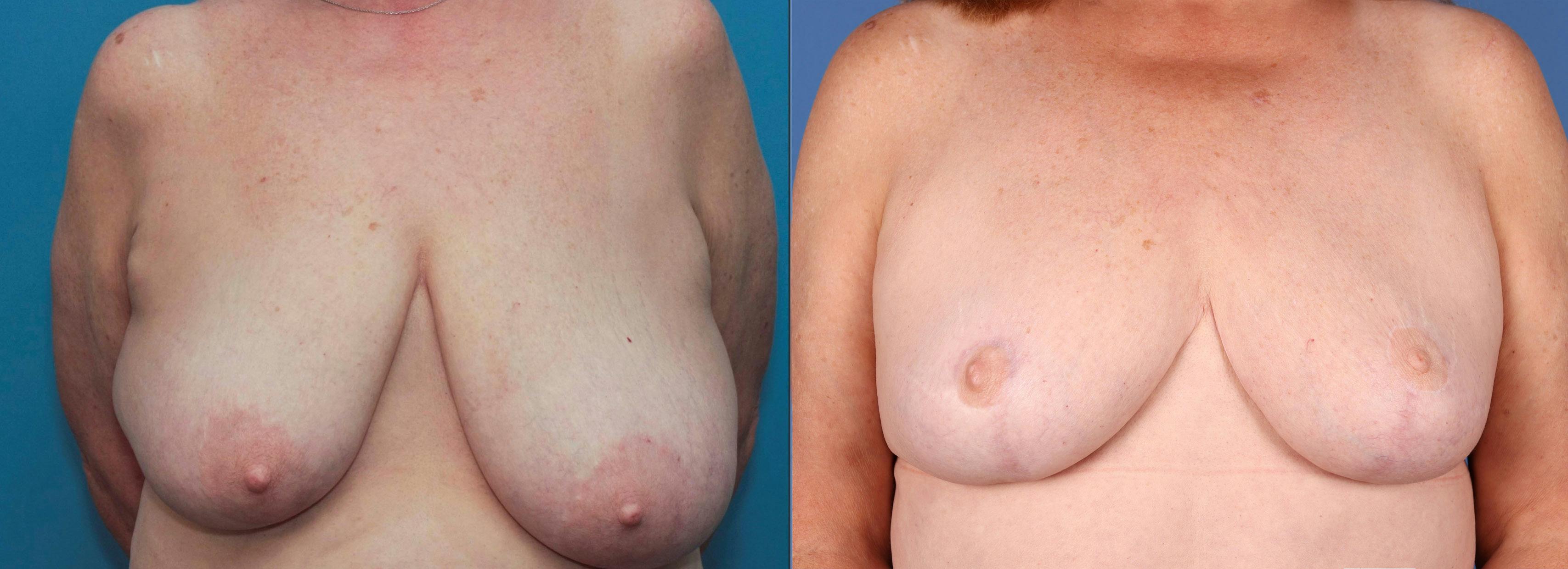 Breast Reduction Before & After Gallery - Patient 141726358 - Image 1