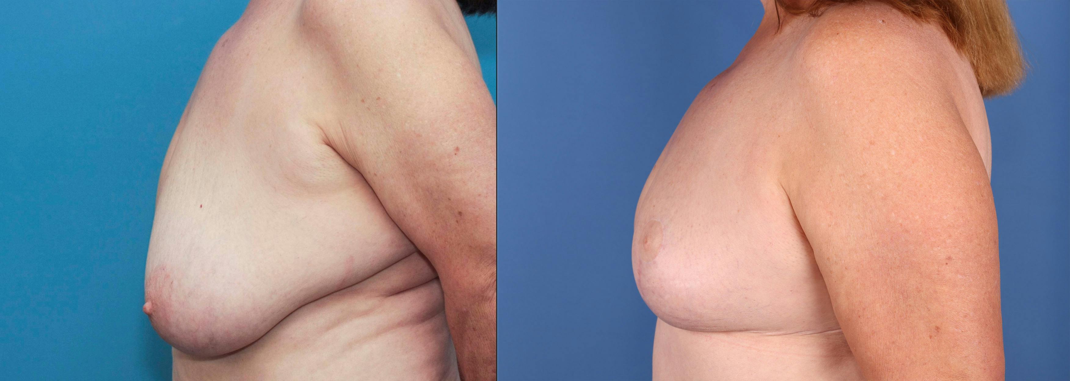 Breast Reduction Before & After Gallery - Patient 141726358 - Image 3