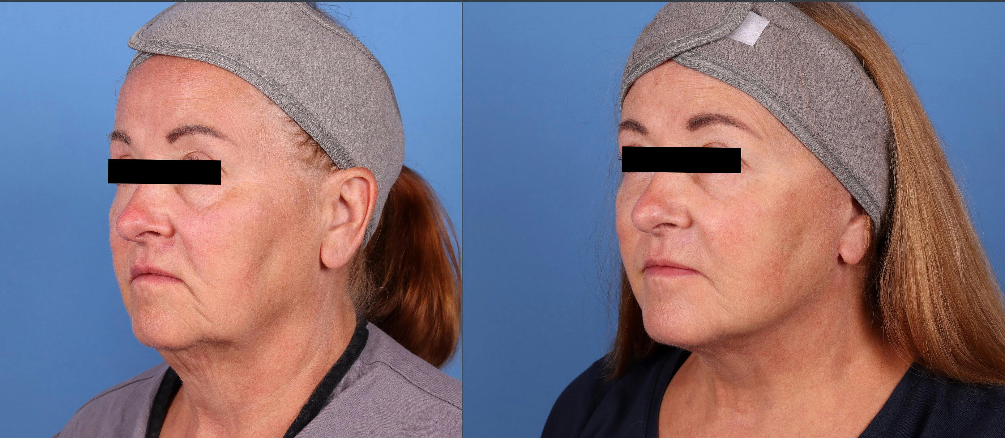 Face Lift Before & After Gallery - Patient 141726657 - Image 2