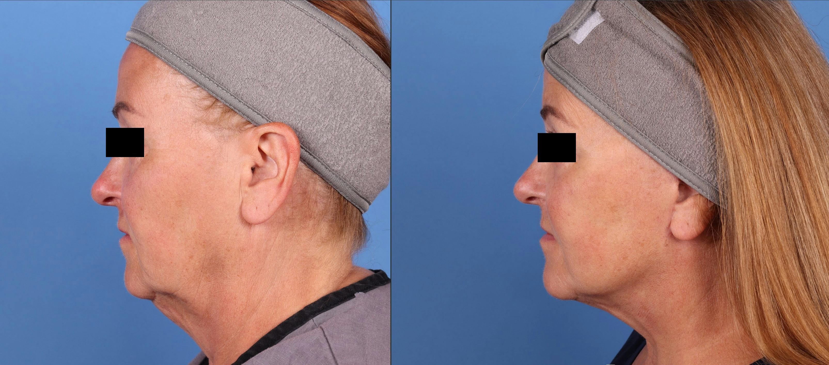 Neck Lift Before & After Gallery - Patient 141726677 - Image 1