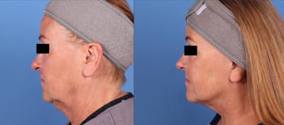 Neck Lift Before & After Gallery - Patient 141726677 - Image 1
