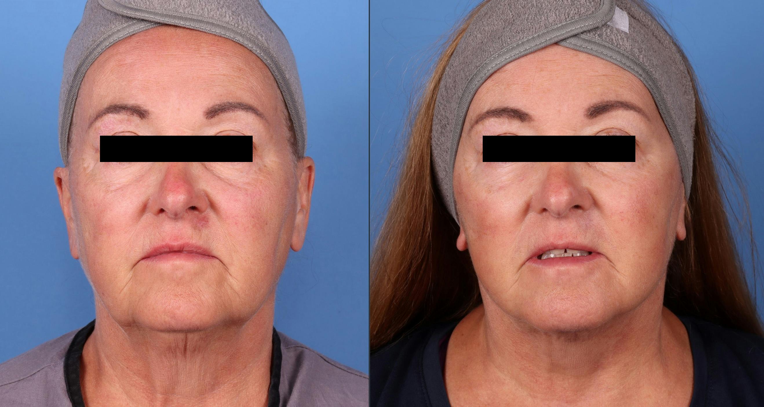 Face Lift Before & After Gallery - Patient 141726657 - Image 1