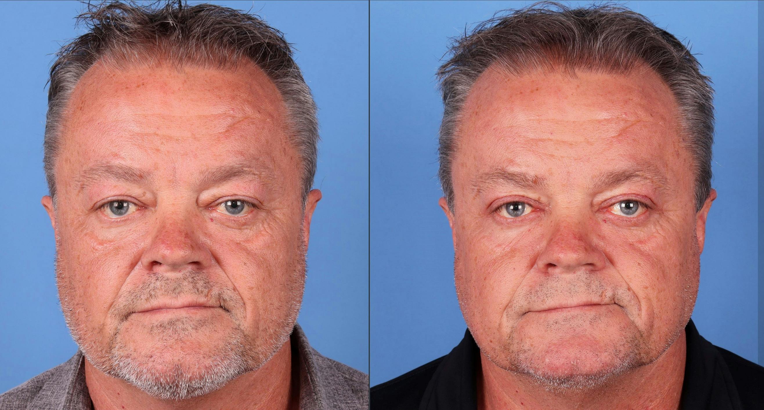 Eyelid Surgery (Upper Blepharoplasty) Before & After Gallery - Patient 142785070 - Image 1