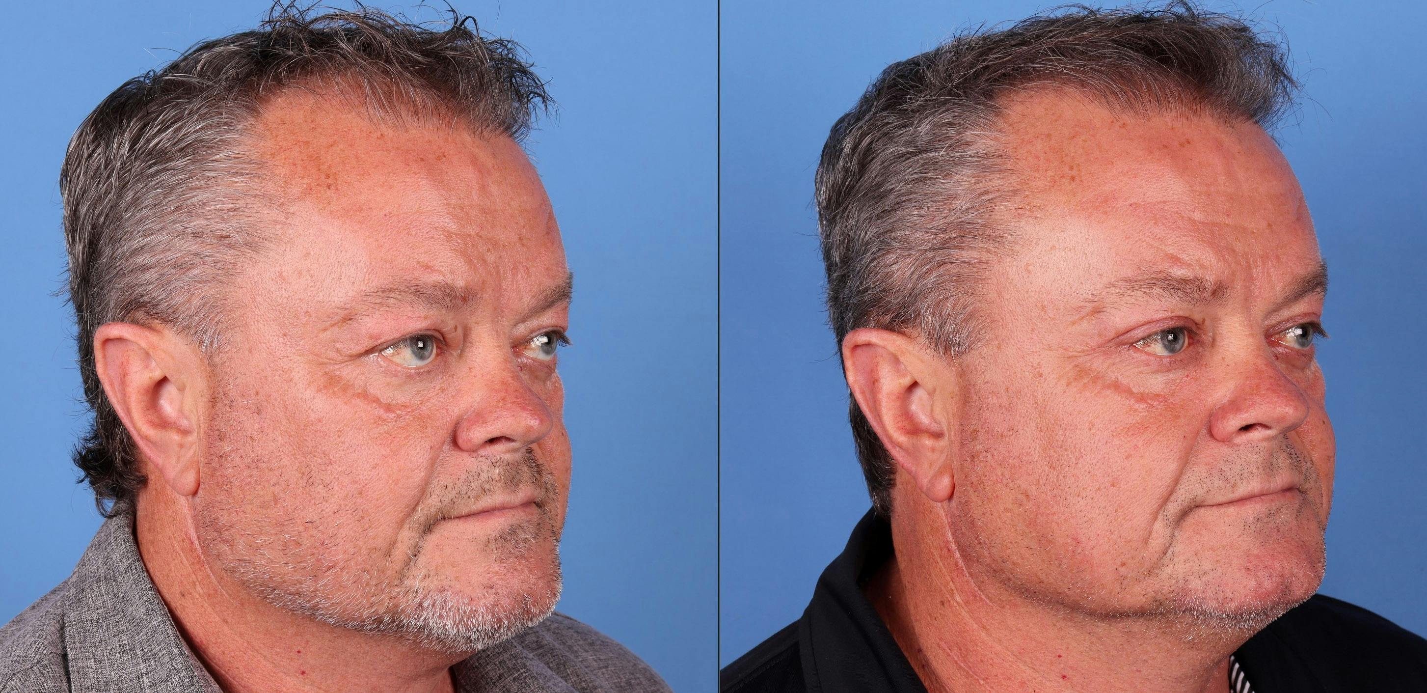 Eyelid Surgery (Blepharoplasty) Before & After Gallery - Patient 142785070 - Image 2