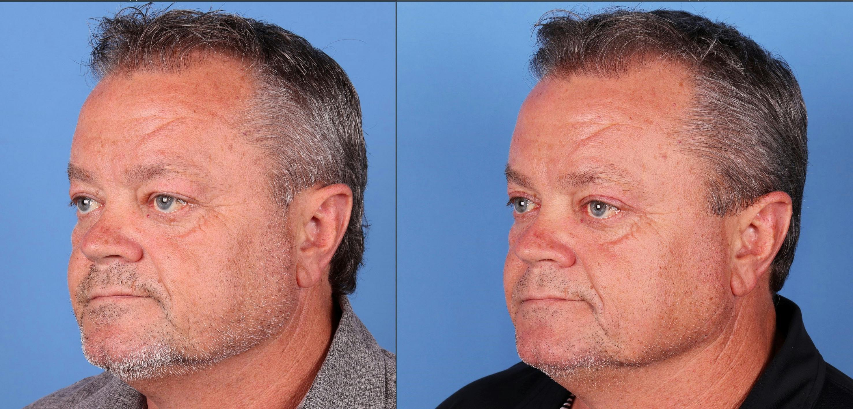 Eyelid Surgery (Upper Blepharoplasty) Before & After Gallery - Patient 142785070 - Image 3