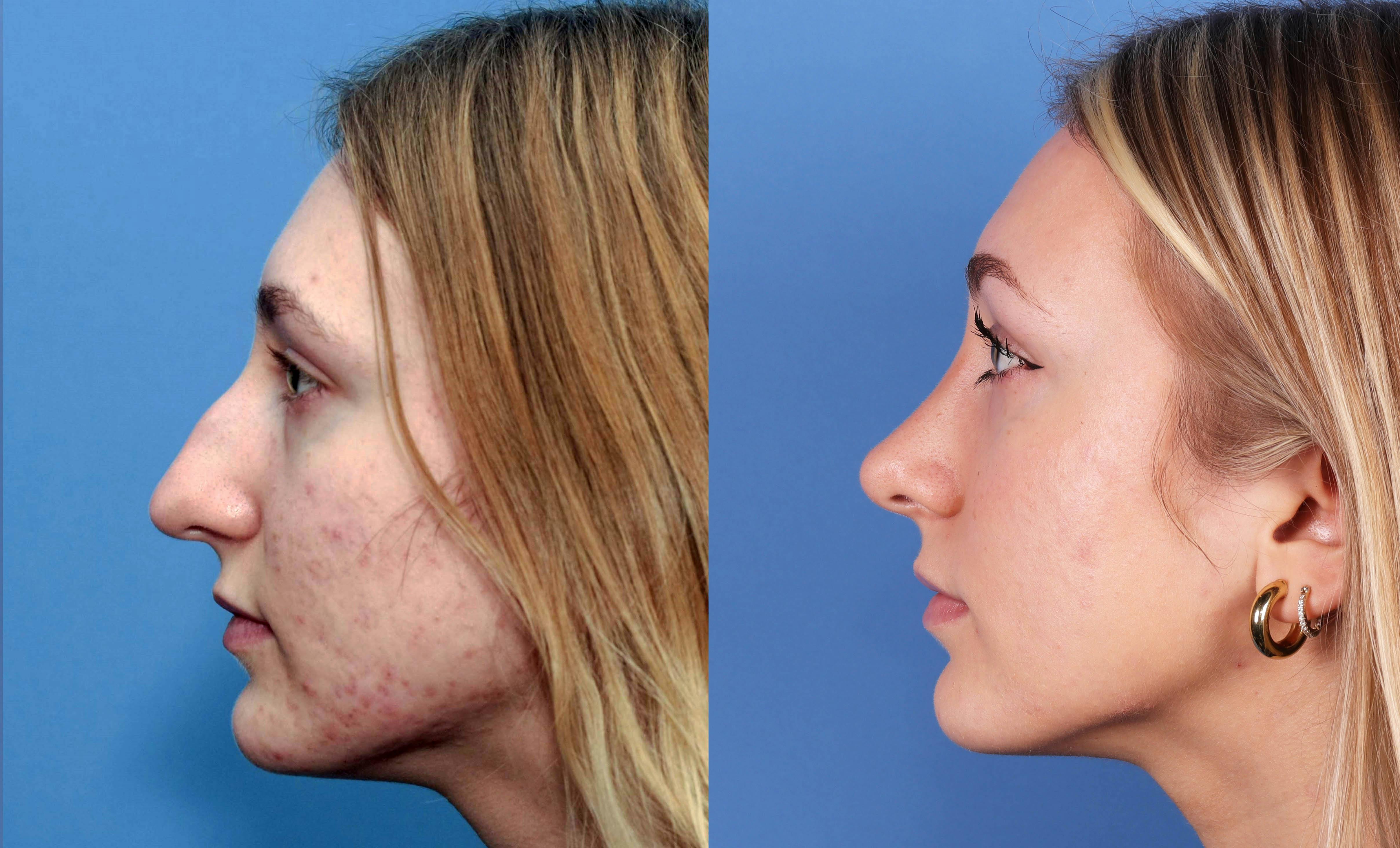 Rhinoplasty Before & After Gallery - Patient 142944505 - Image 3