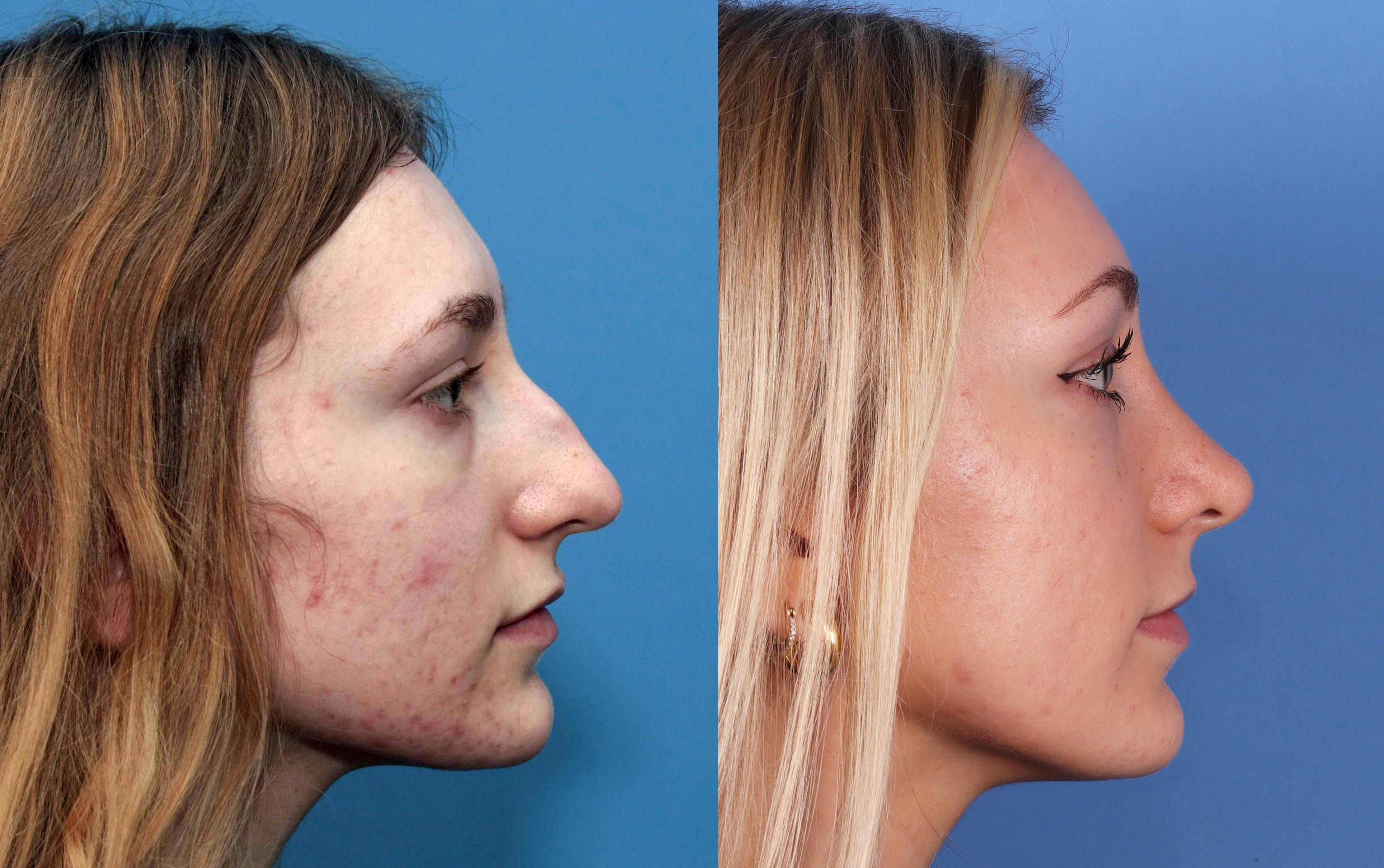 Rhinoplasty Before & After Gallery - Patient 142944505 - Image 5