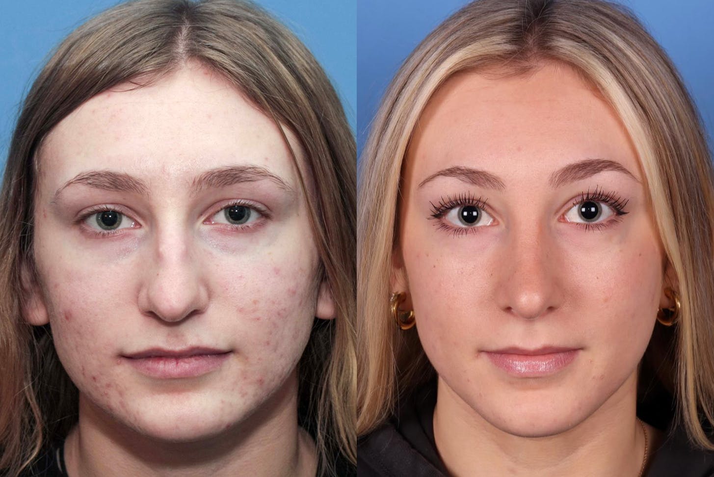 Rhinoplasty Before & After Gallery - Patient 142944505 - Image 1