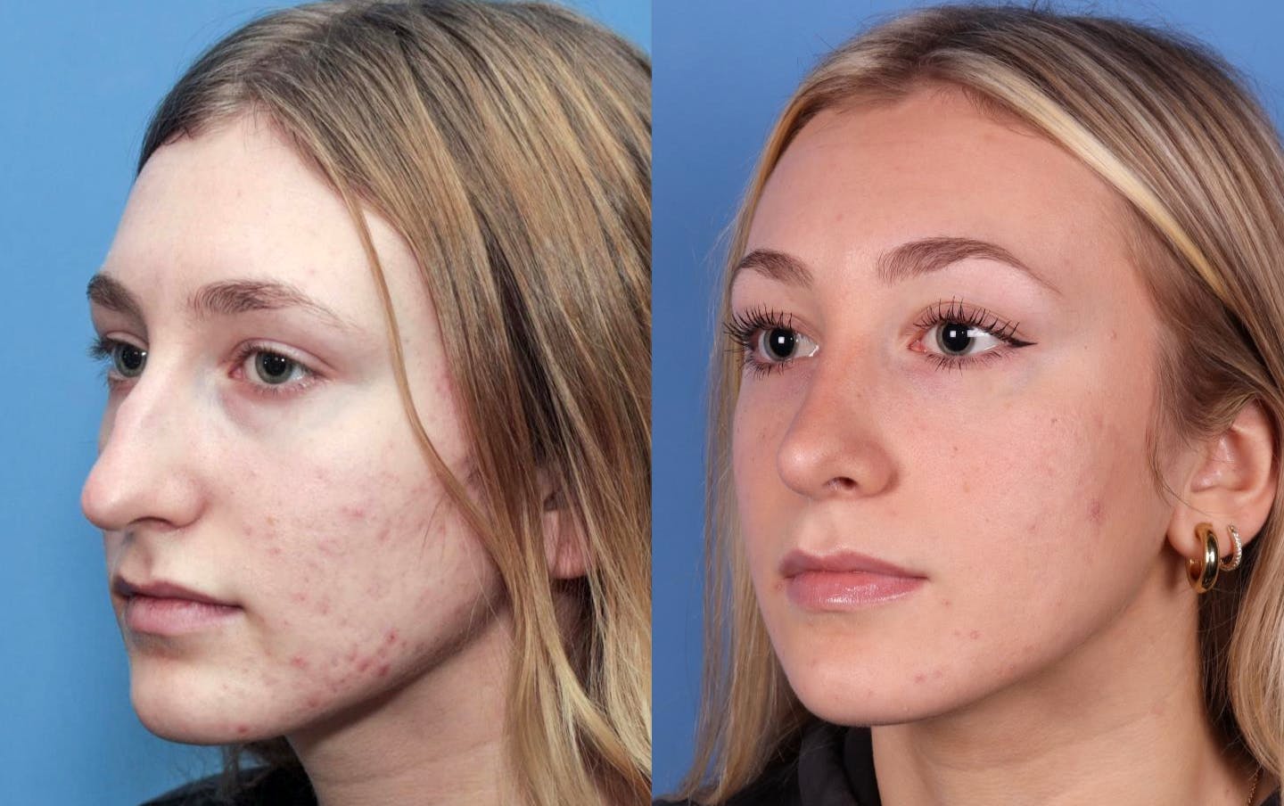 Rhinoplasty Before & After Gallery - Patient 142944505 - Image 2