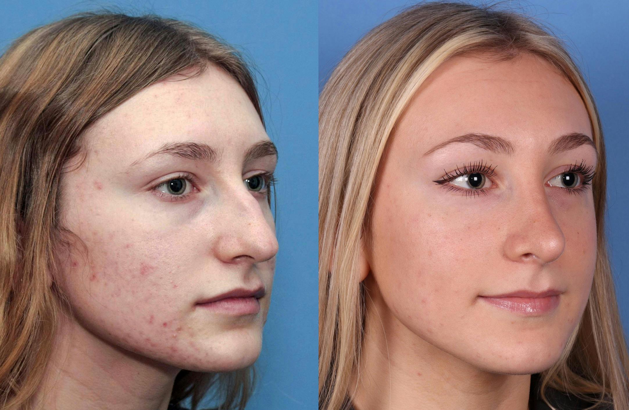 Rhinoplasty Before & After Gallery - Patient 142944505 - Image 4