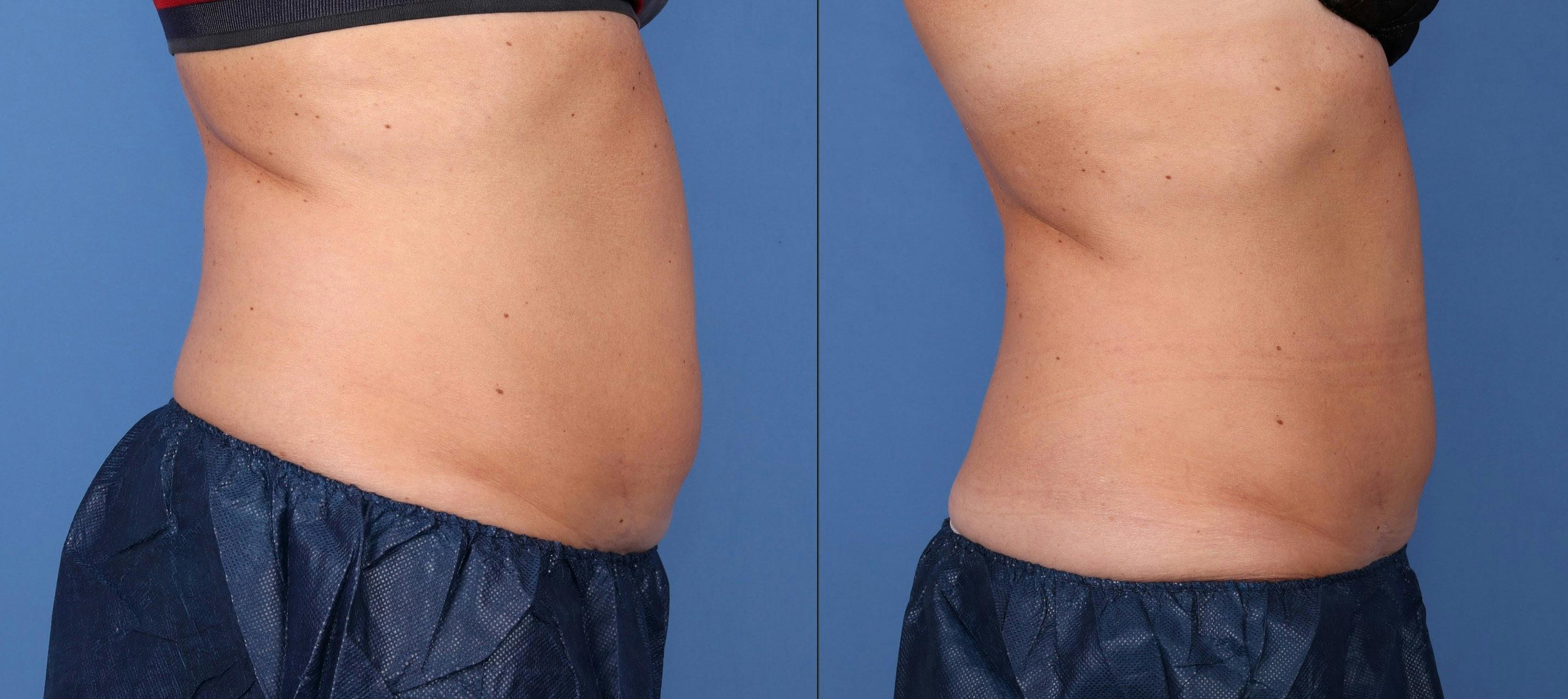 Body Before & After Gallery - Patient 143020140 - Image 3