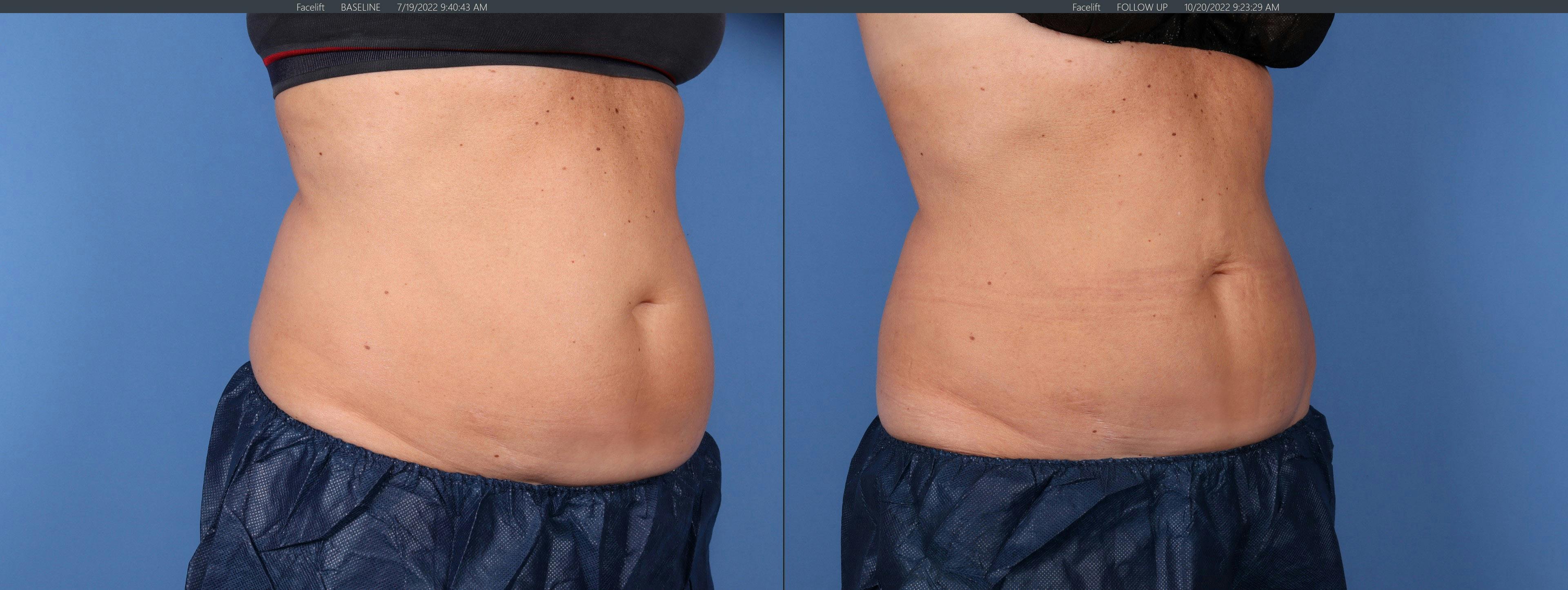 Body Before & After Gallery - Patient 143020140 - Image 2