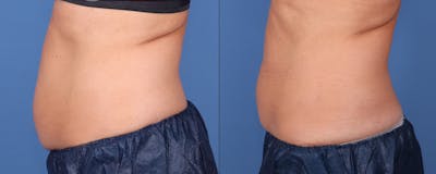 Body Before & After Gallery - Patient 143020140 - Image 1