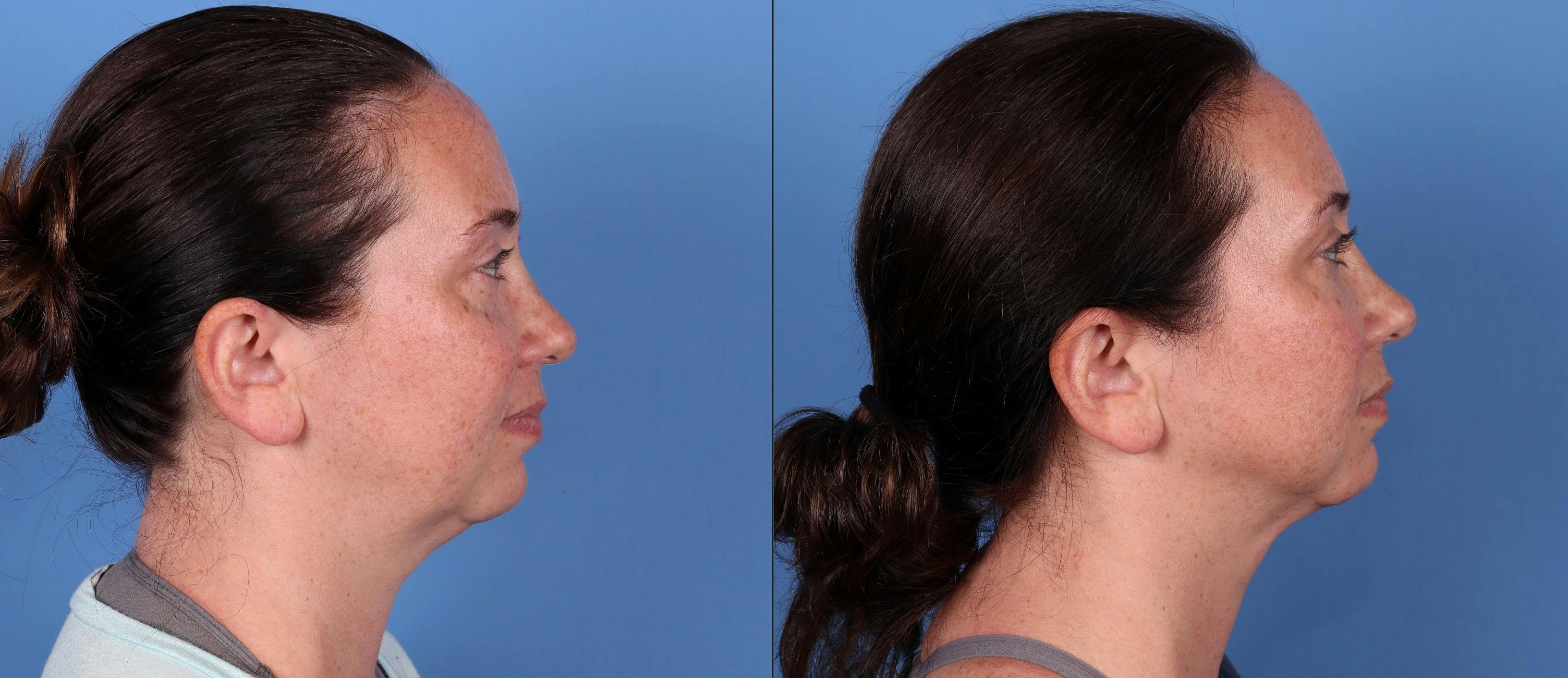 Face Before & After Gallery - Patient 149385114 - Image 5