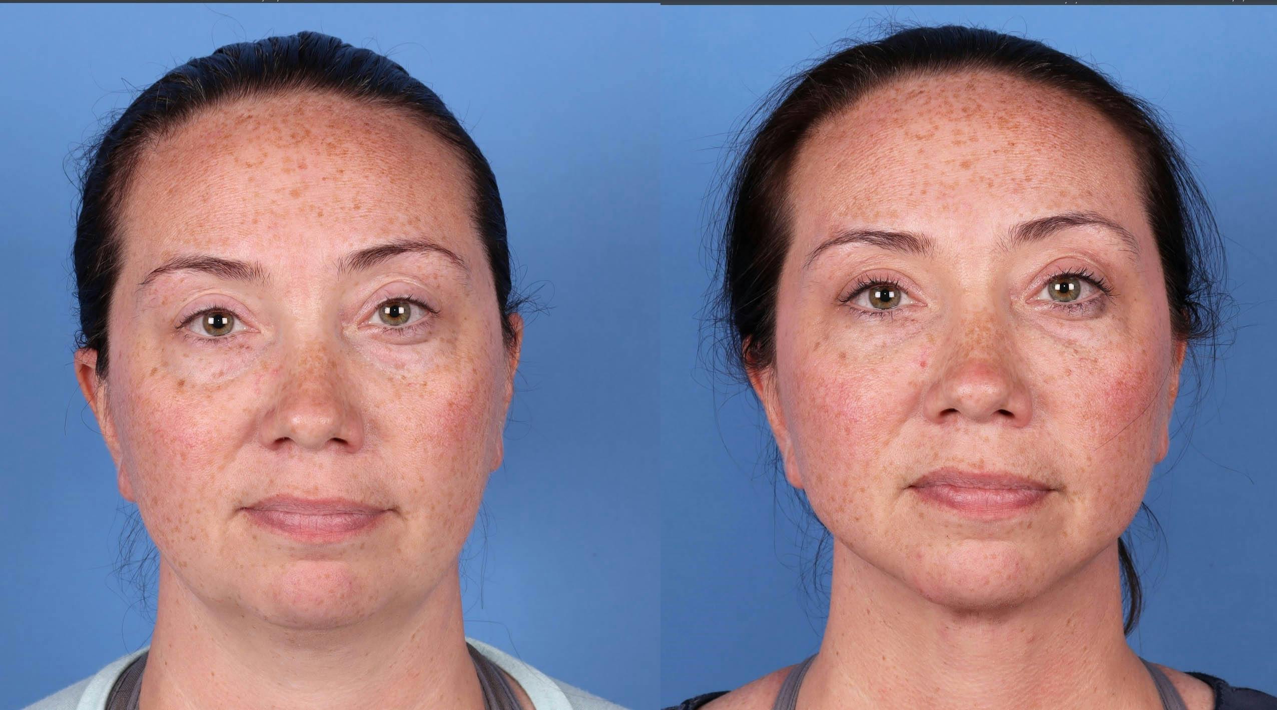 Face Before & After Gallery - Patient 149385114 - Image 1