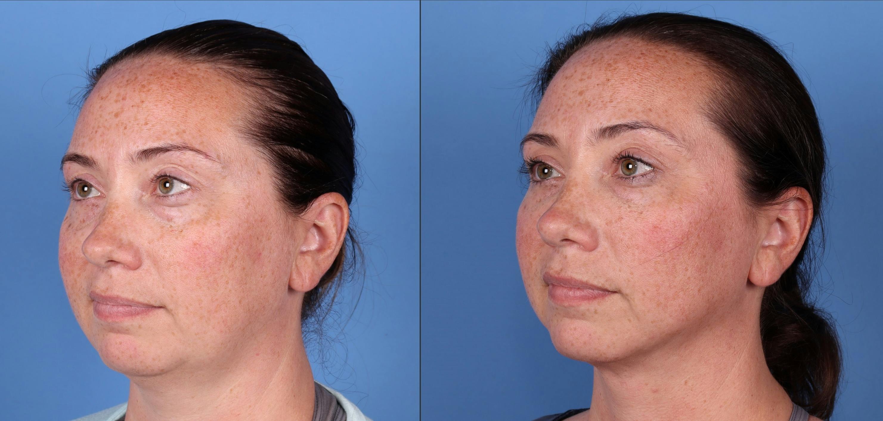 Face & Neck Before & After Gallery - Patient 149385114 - Image 2
