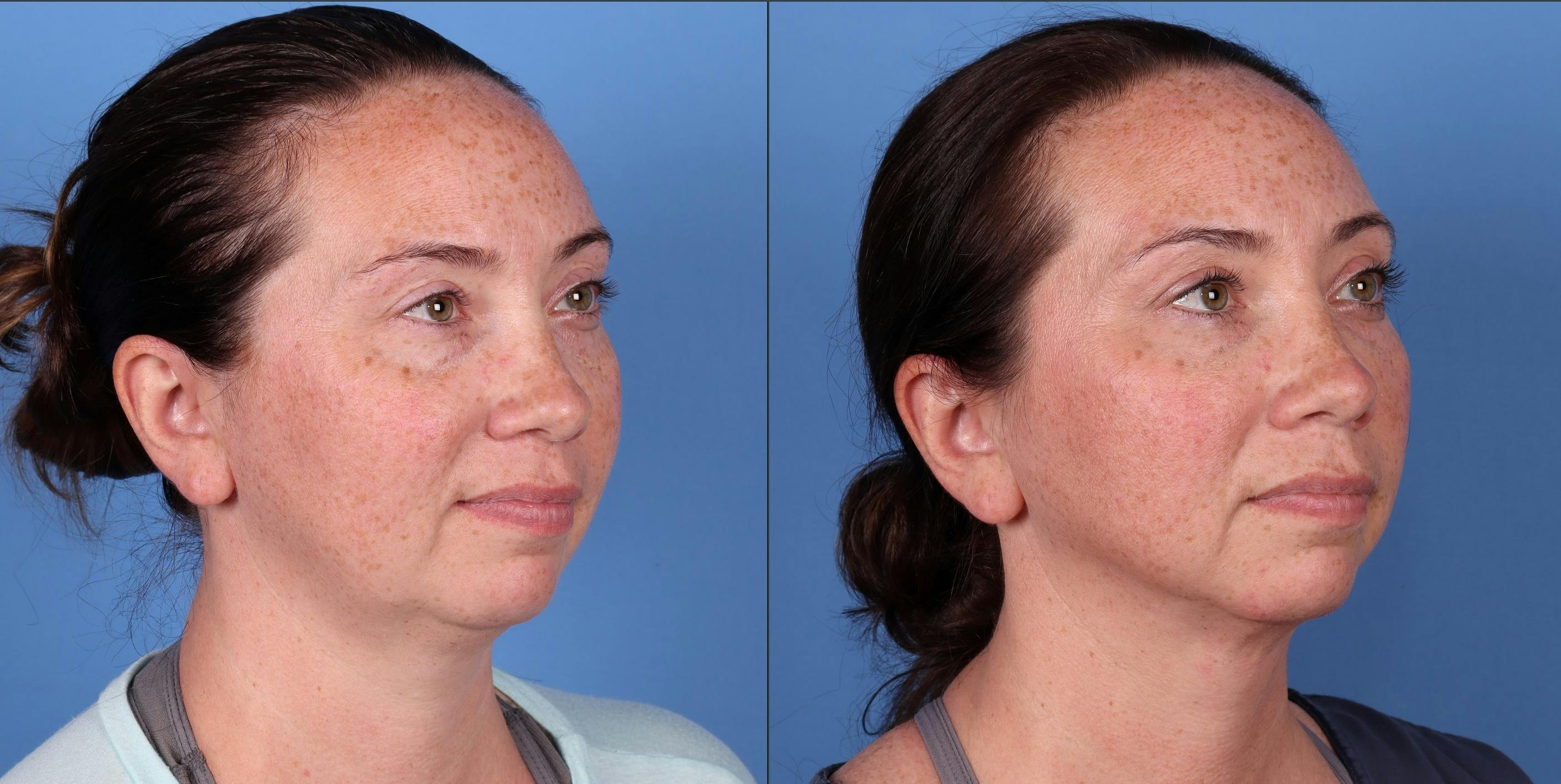 Face Before & After Gallery - Patient 149385114 - Image 4