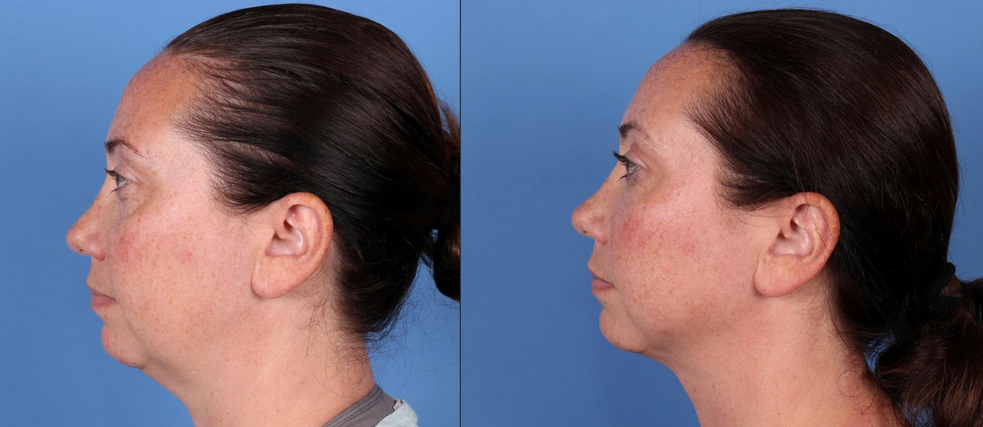 Face Before & After Gallery - Patient 149385114 - Image 3