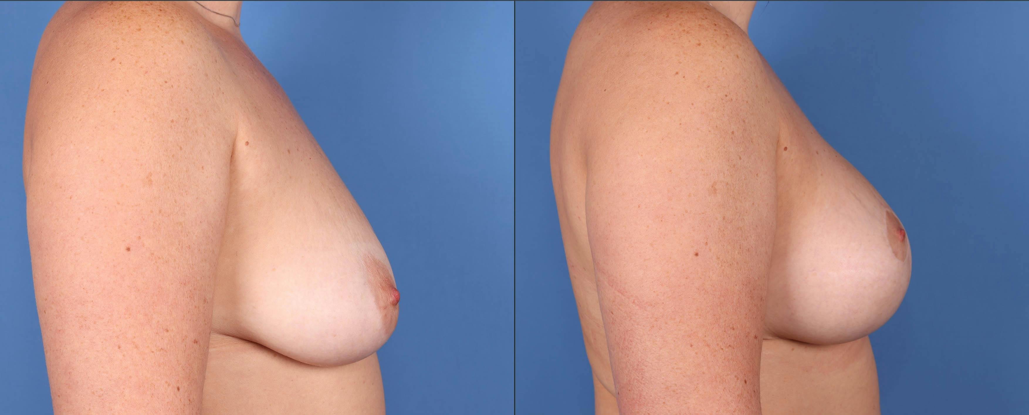 Breast Lift Before & After Gallery - Patient 143364702 - Image 3