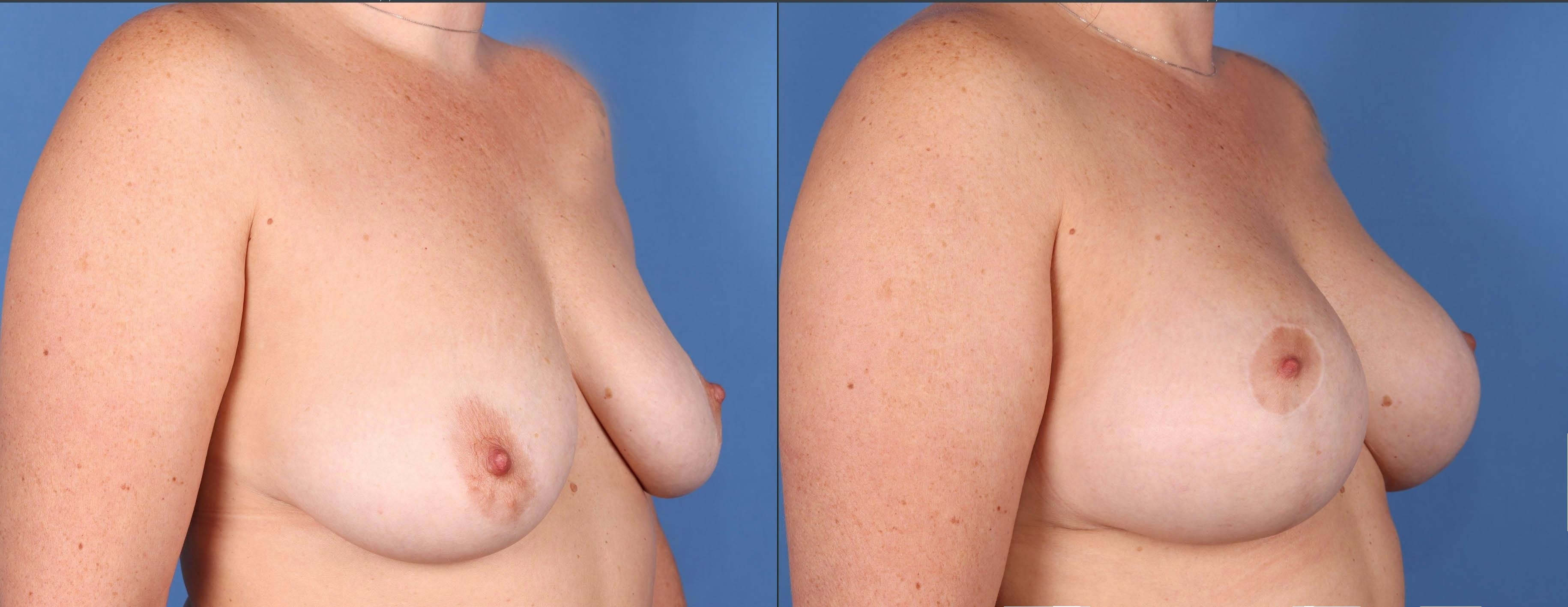 Breast Lift Before & After Gallery - Patient 143364702 - Image 2