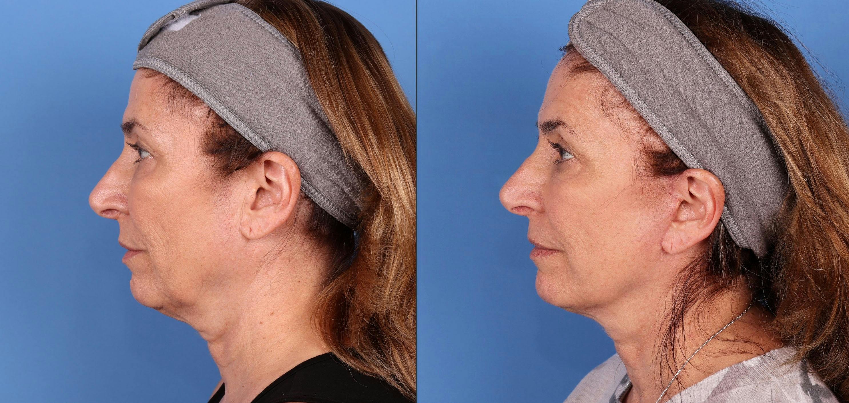 Mini Facelift Before & After Gallery - Patient 143416270 - Image 3