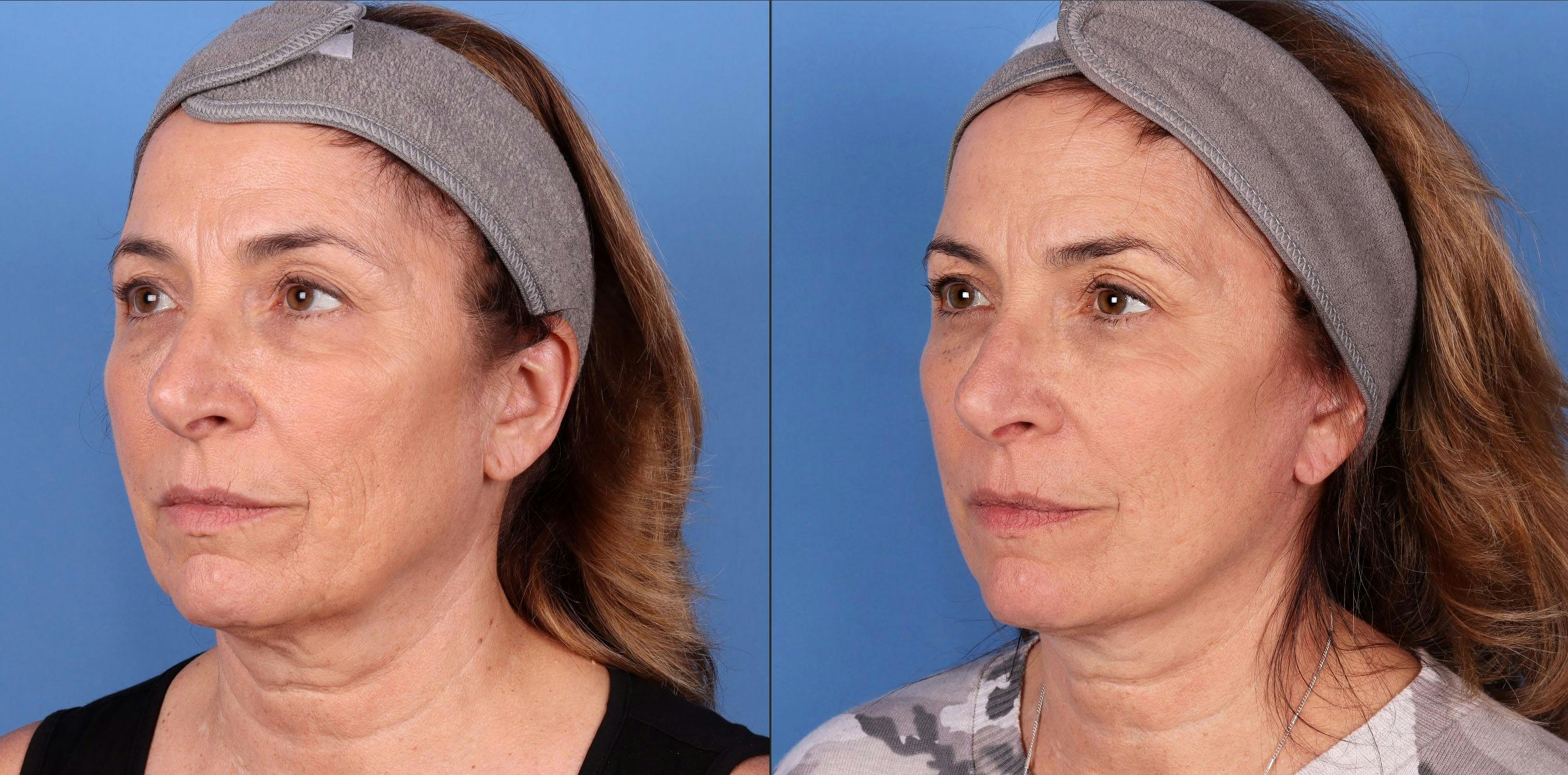 Mini Facelift Before & After Gallery - Patient 143416270 - Image 2