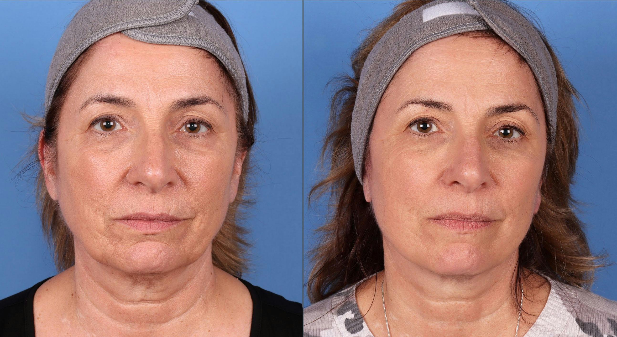 Mini Facelift Before & After Gallery - Patient 143416270 - Image 1