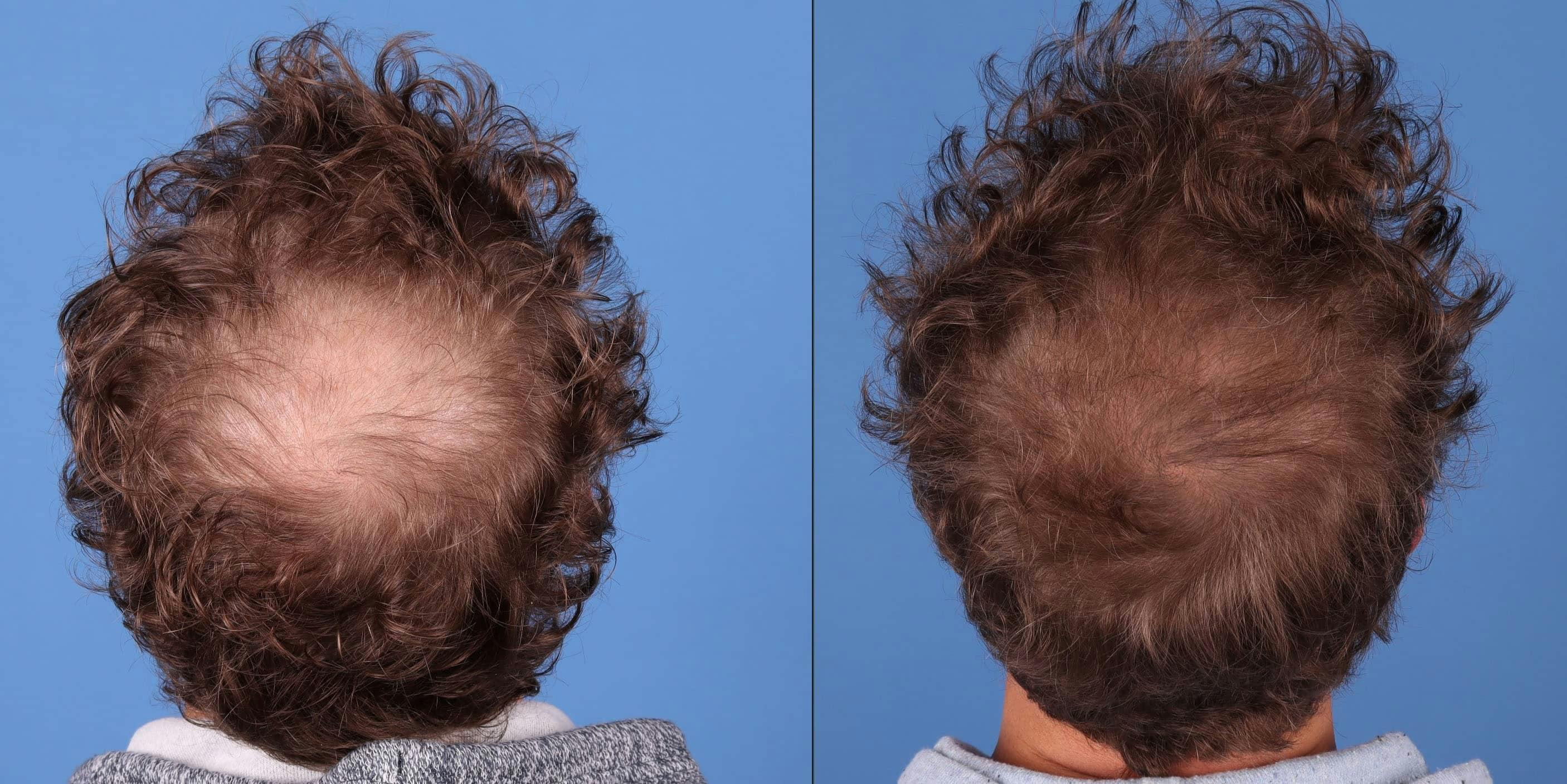 NeoGraft Hair Restoration Before & After Gallery - Patient 143618505 - Image 1