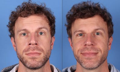 NeoGraft Hair Restoration Before & After Gallery - Patient 143618505 - Image 1