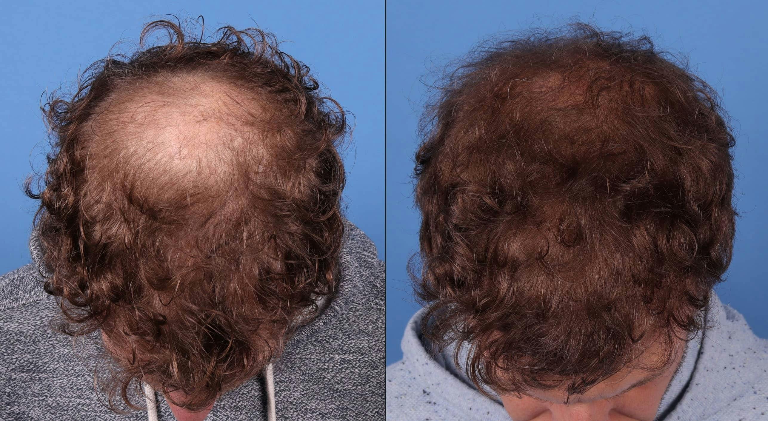 NeoGraft Hair Restoration Before & After Gallery - Patient 143618505 - Image 4