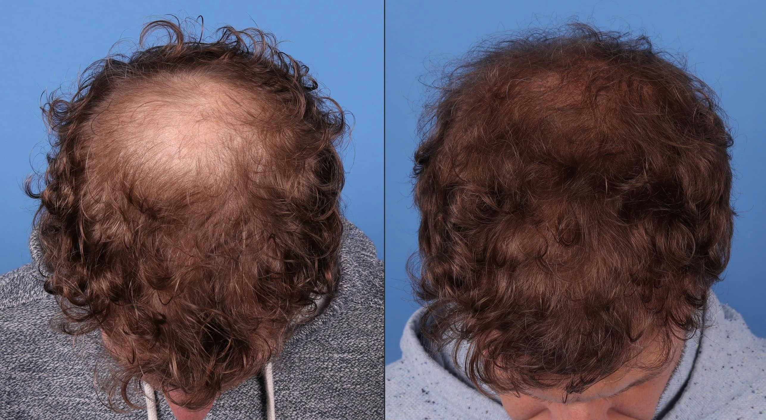 NeoGraft Hair Restoration Before & After Gallery - Patient 143618505 - Image 3