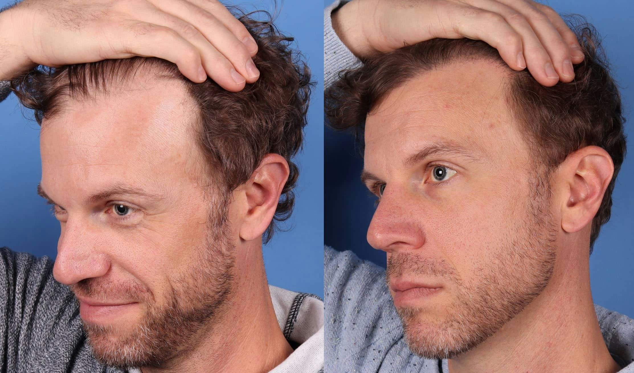 NeoGraft Hair Restoration Before & After Gallery - Patient 143618505 - Image 4