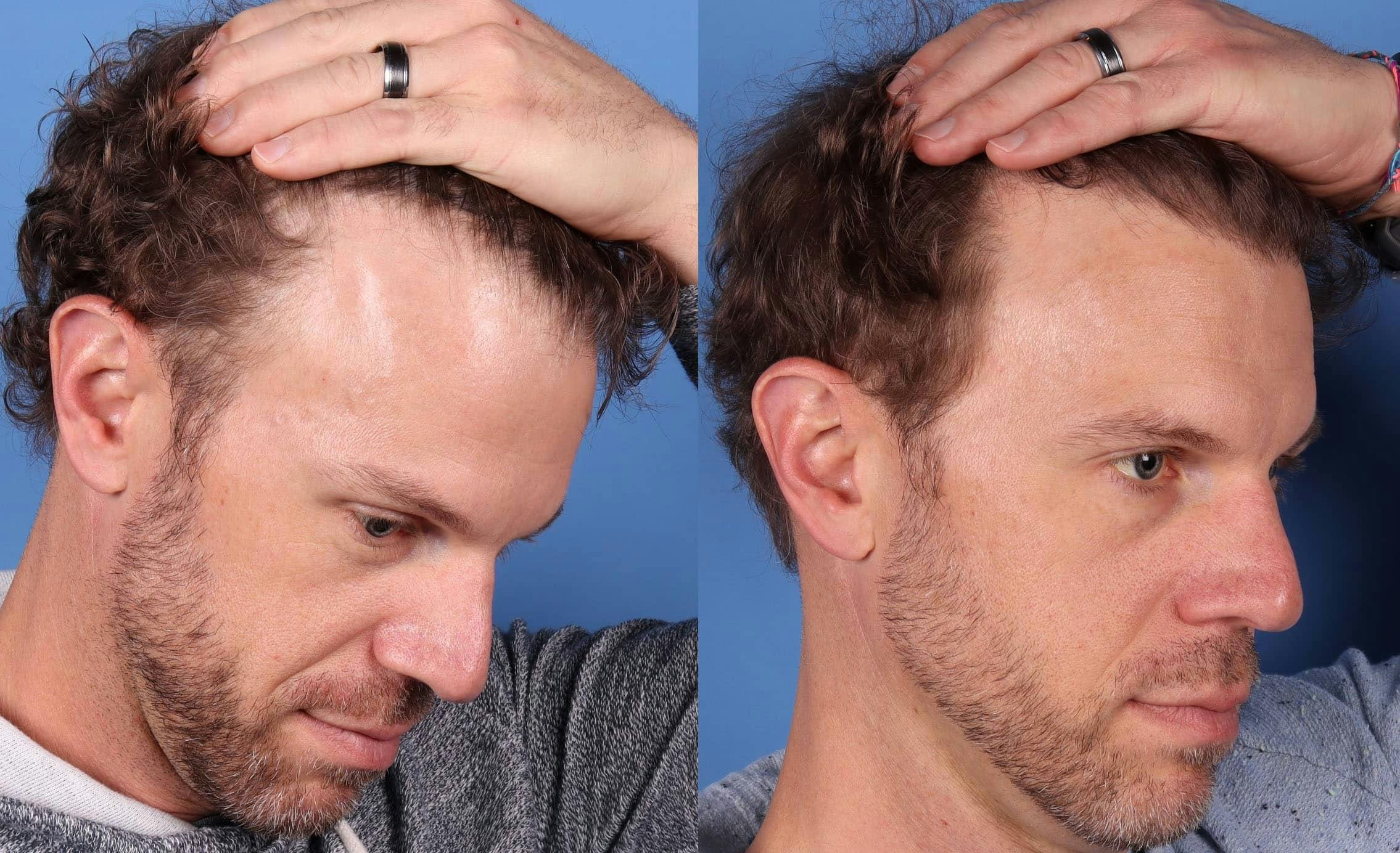 NeoGraft Hair Restoration Before & After Gallery - Patient 143618505 - Image 5