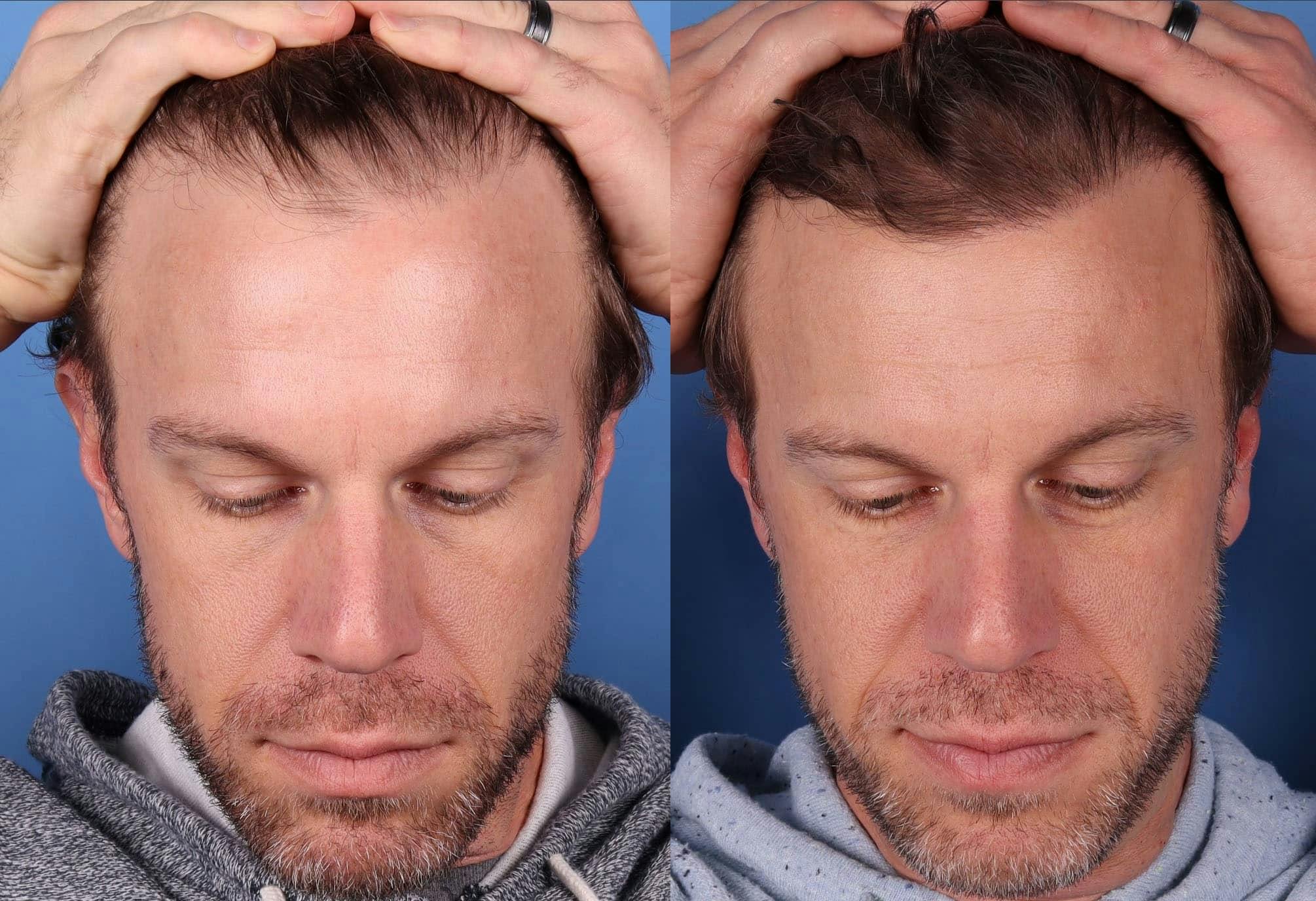 NeoGraft Hair Restoration Before & After Gallery - Patient 143618505 - Image 6