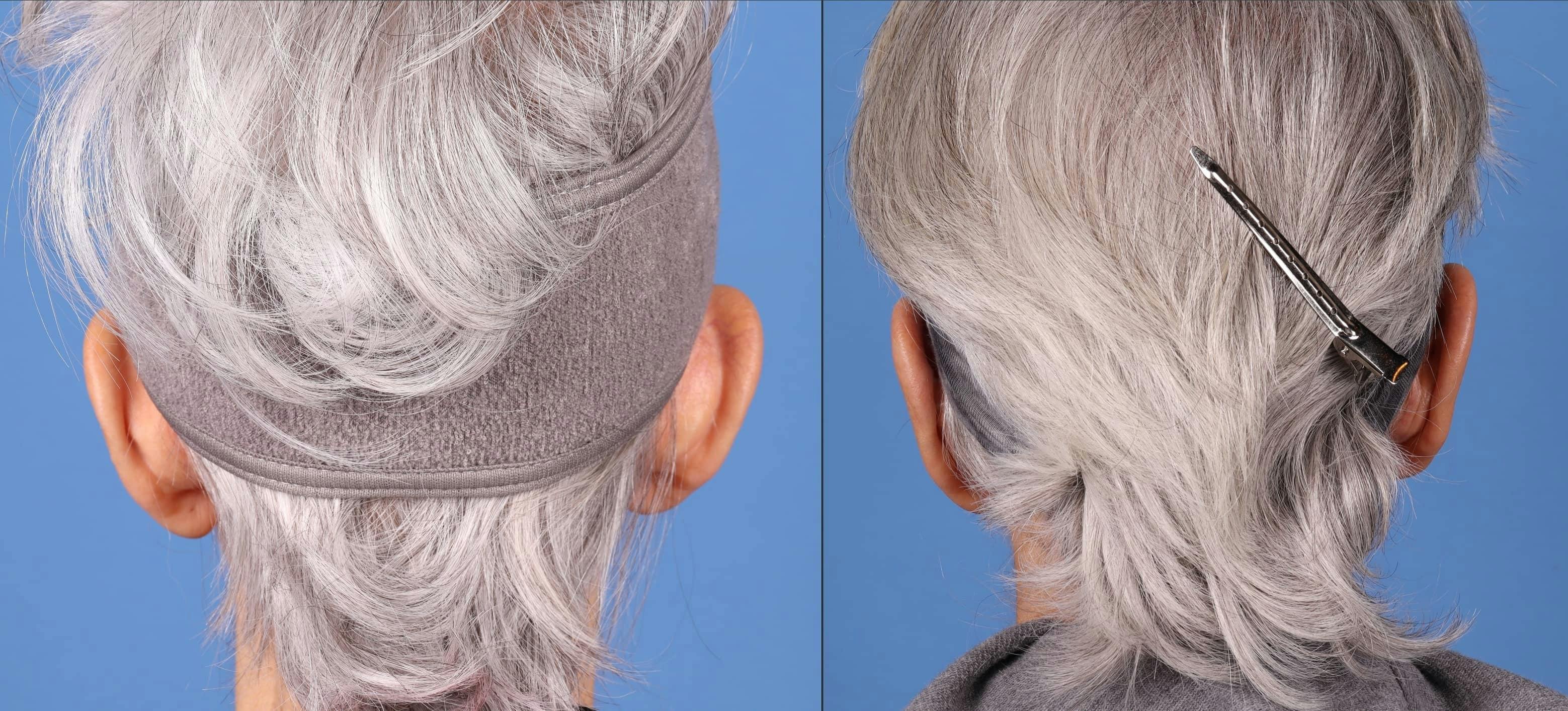 Otoplasty Before & After Gallery - Patient 143618689 - Image 6
