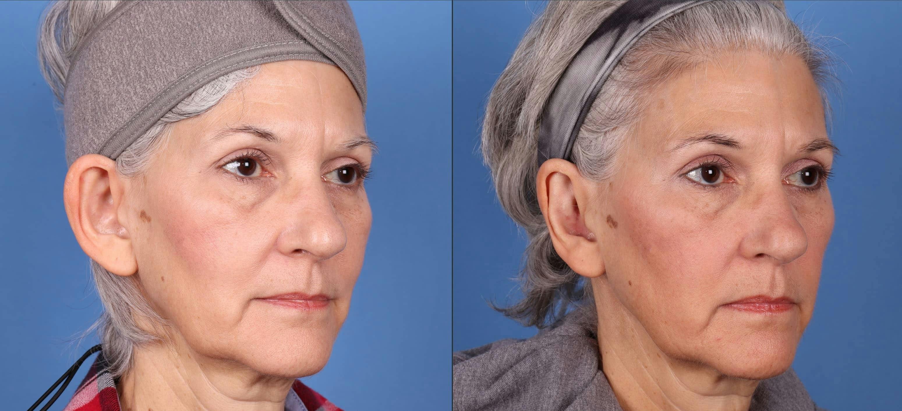 Otoplasty Before & After Gallery - Patient 143618689 - Image 2