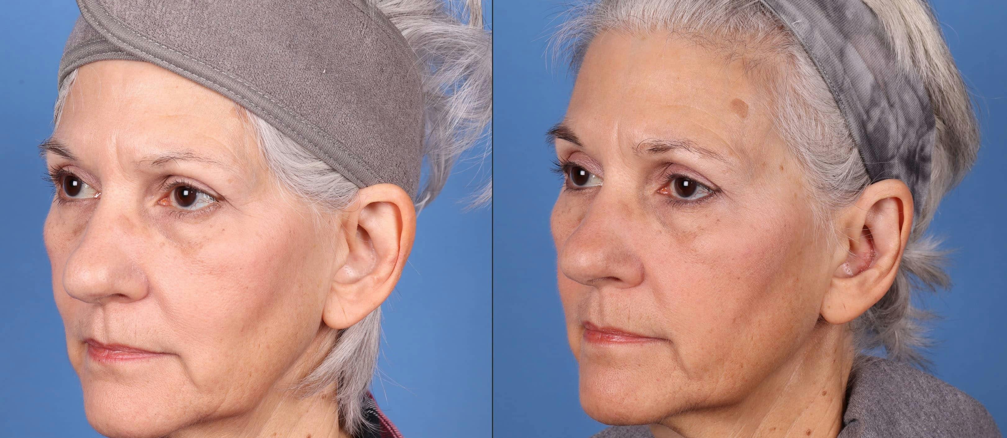 Otoplasty Before & After Gallery - Patient 143618689 - Image 3
