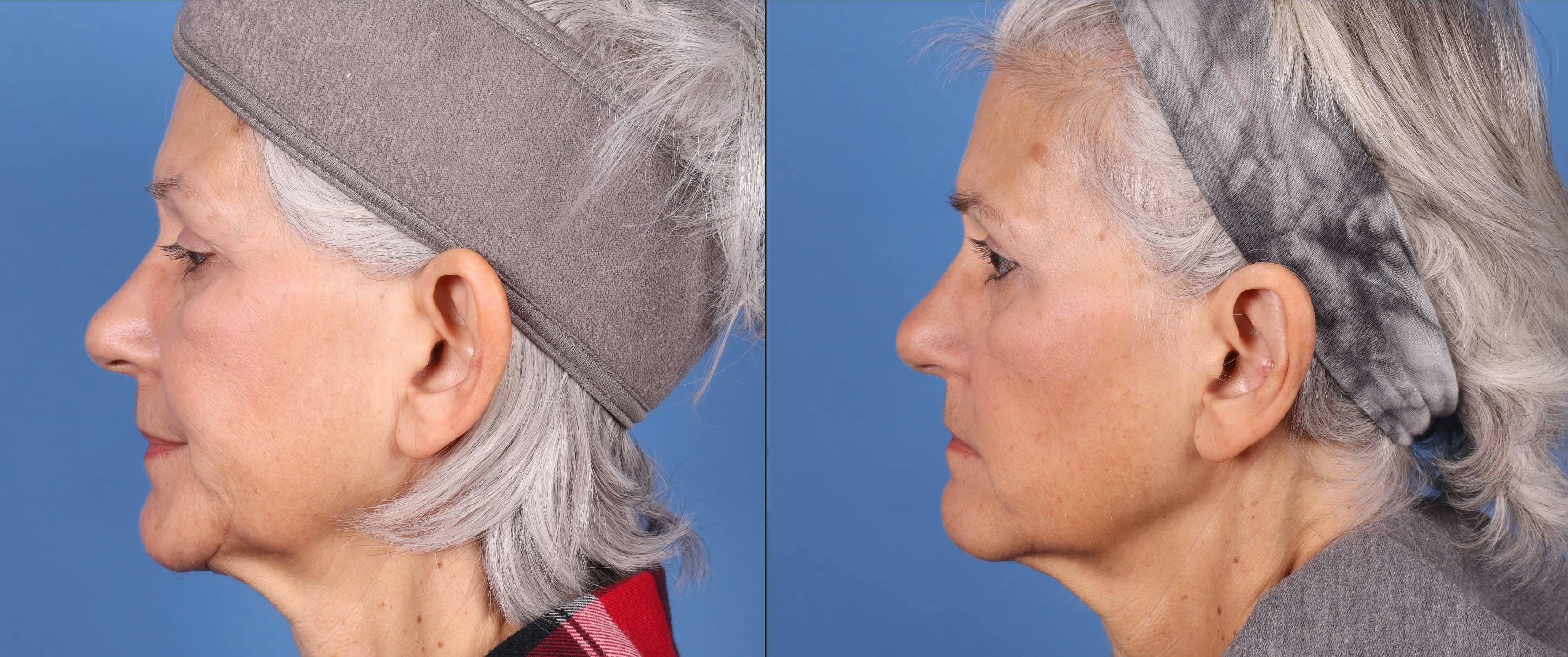 Otoplasty Before & After Gallery - Patient 143618689 - Image 4