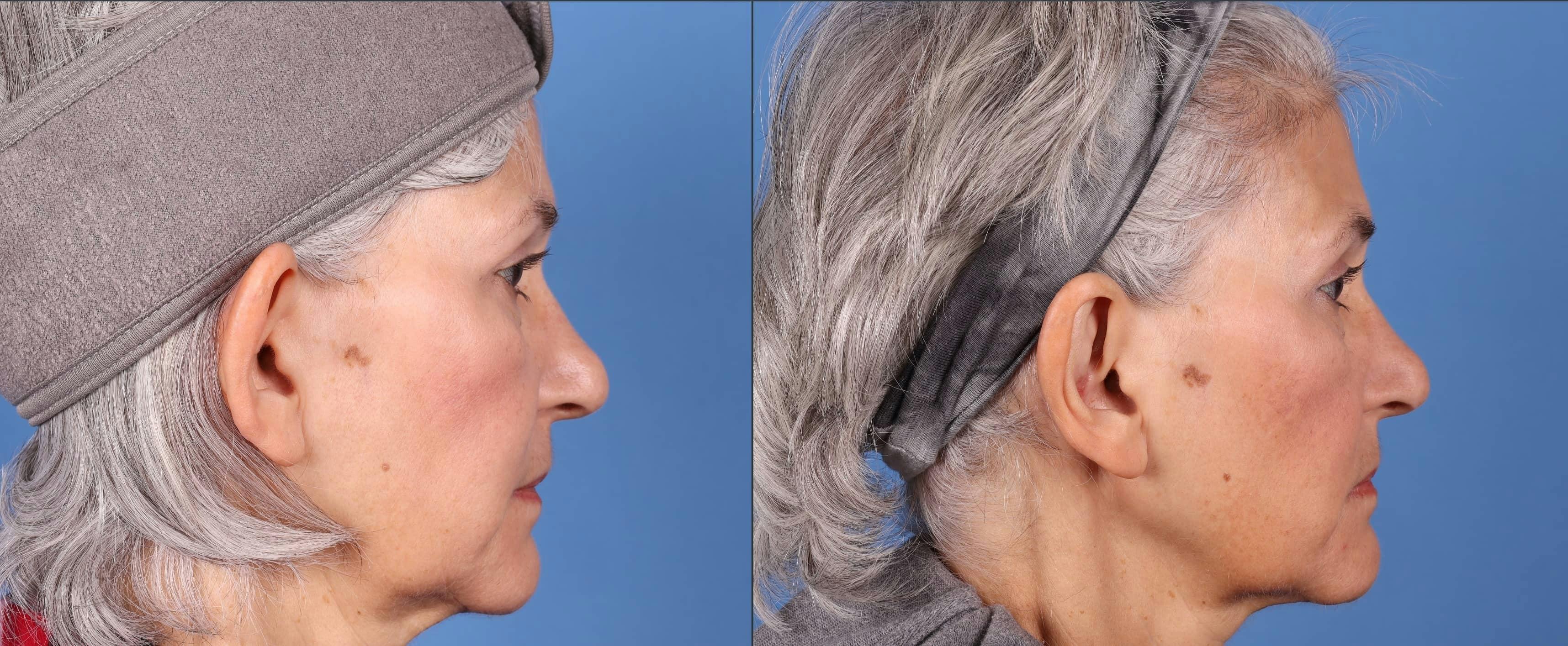 Otoplasty Before & After Gallery - Patient 143618689 - Image 5