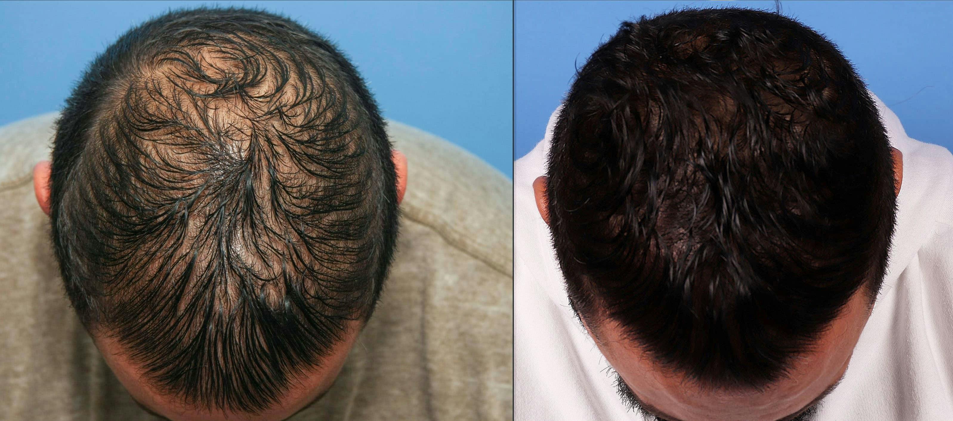NeoGraft Hair Restoration Before & After Gallery - Patient 143674850 - Image 2