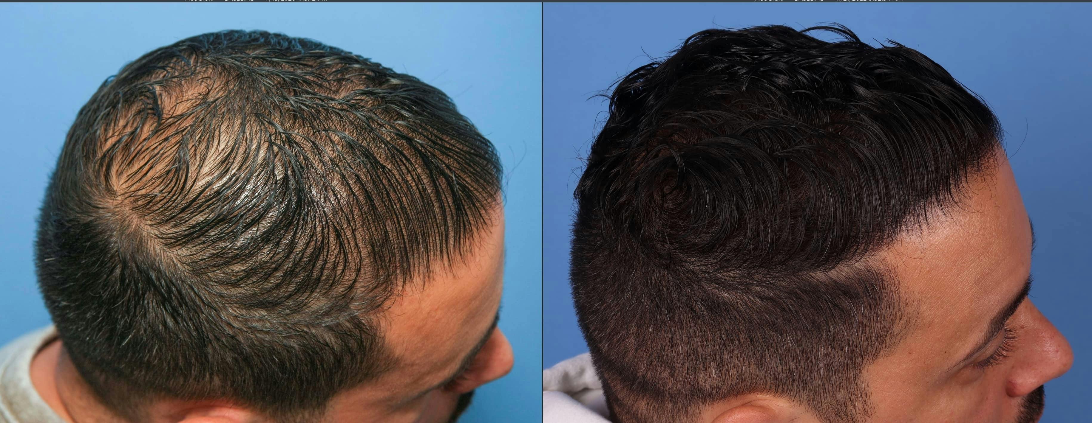 NeoGraft Hair Restoration Before & After Gallery - Patient 143674850 - Image 3