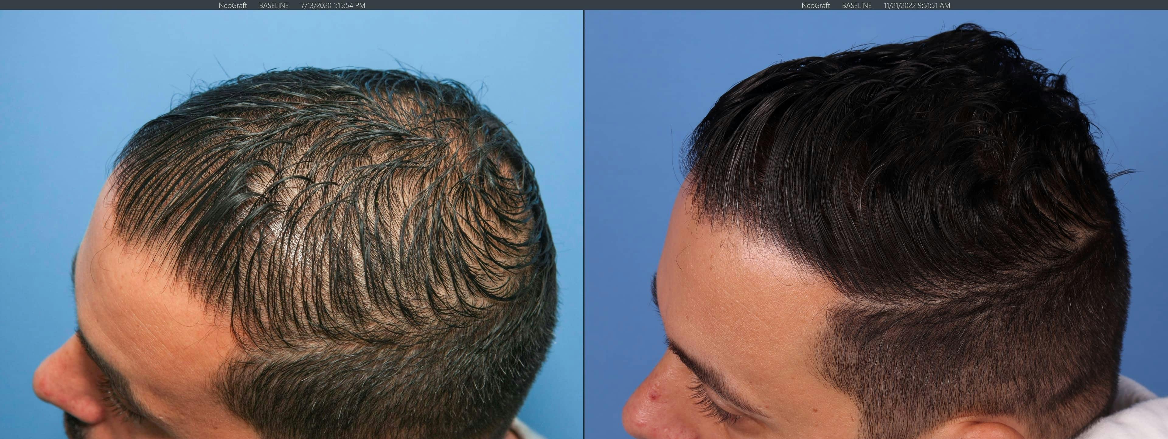 NeoGraft Hair Restoration Before & After Gallery - Patient 143674850 - Image 4