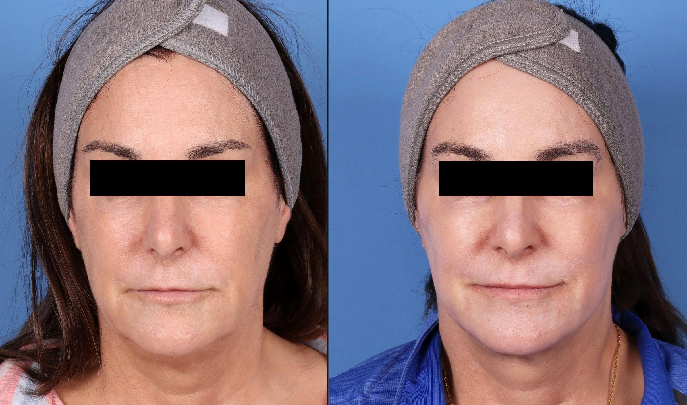 Face Lift Before & After Gallery - Patient 143746665 - Image 1