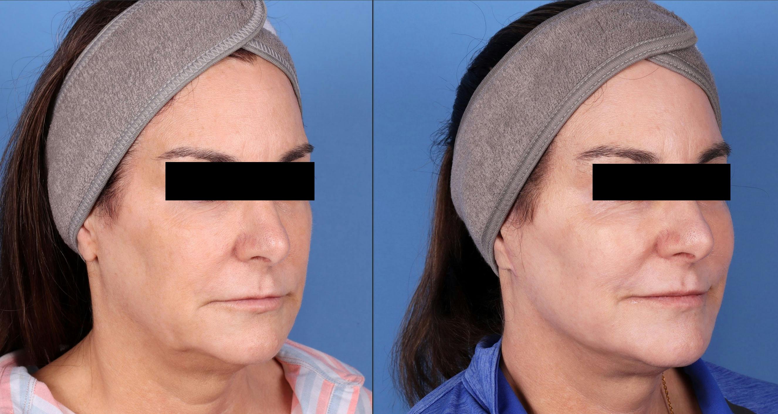 Face Lift Before & After Gallery - Patient 143746665 - Image 2