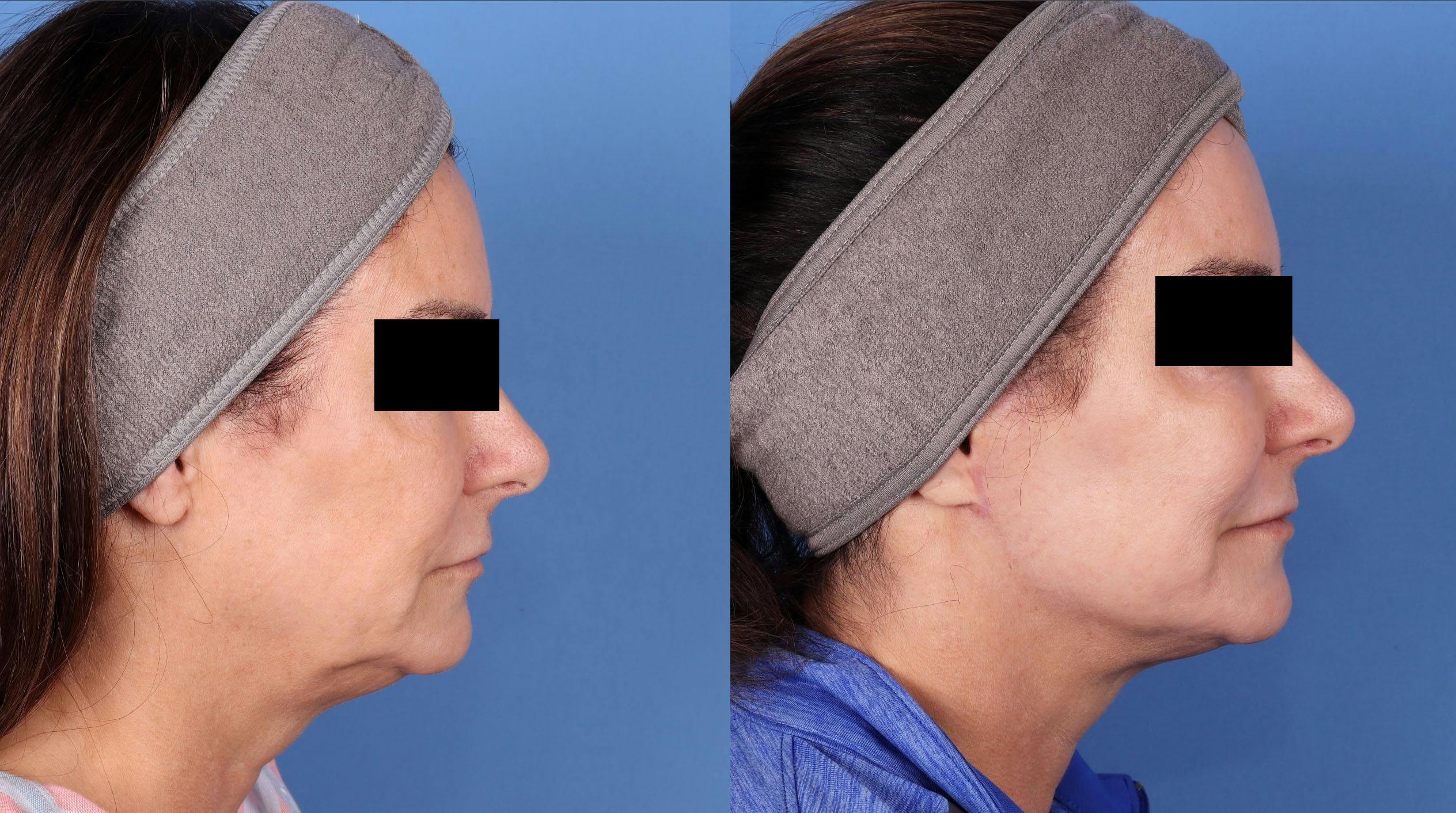 Face Lift Before & After Gallery - Patient 143746665 - Image 3