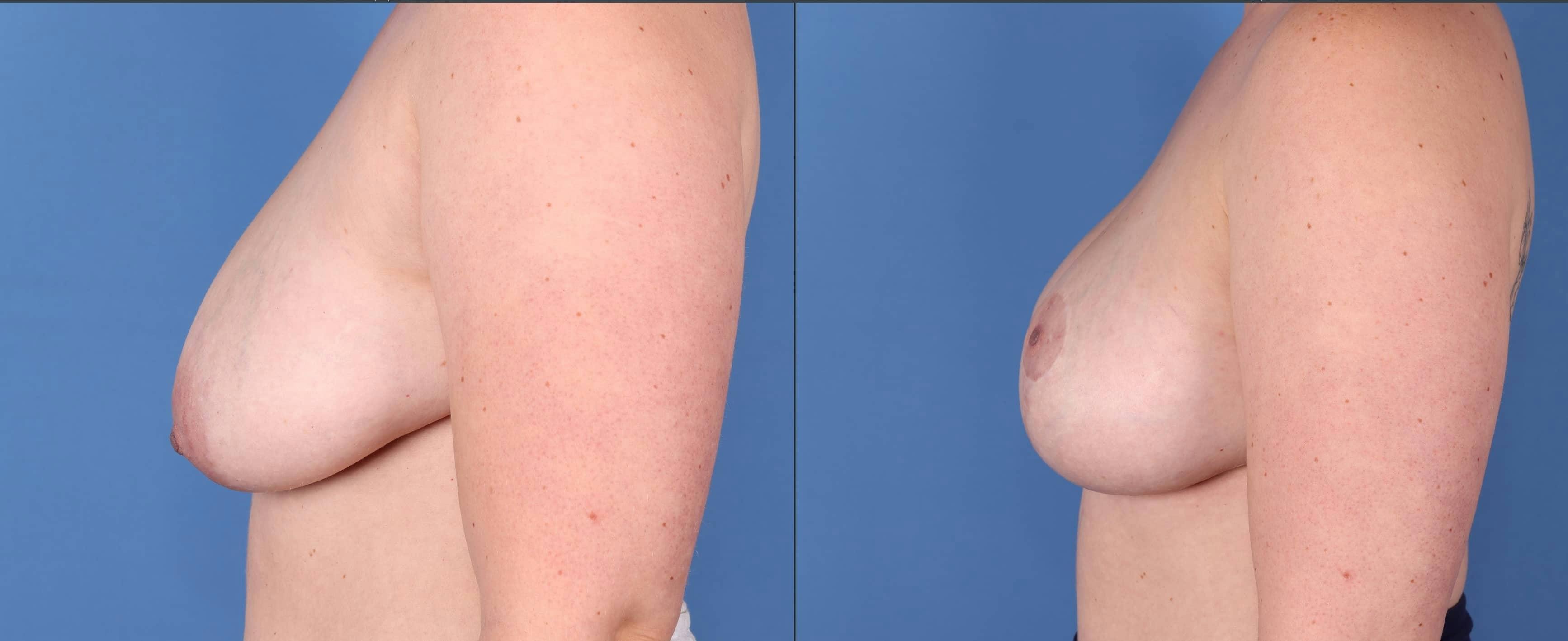 Breast Lift with Augmentation Before & After Gallery - Patient 144211596 - Image 3