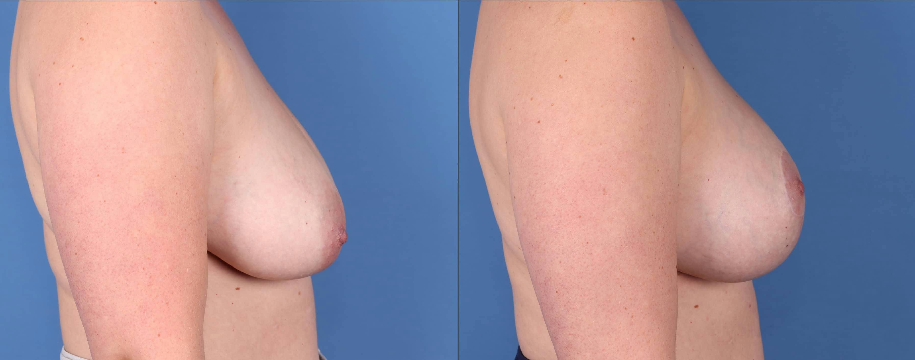 Breast Lift with Augmentation Before & After Gallery - Patient 144211596 - Image 4
