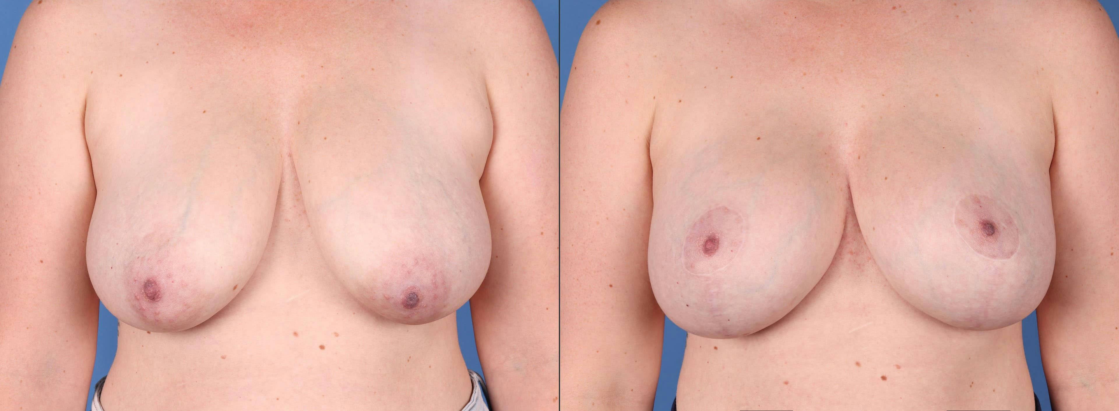 Breast Lift with Augmentation Before & After Gallery - Patient 144211596 - Image 1